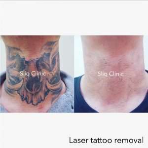 Before and after of laser tattoo removal in Kuala Lumpur
