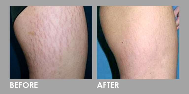 Stretch Mark Removal Before After 768x384 