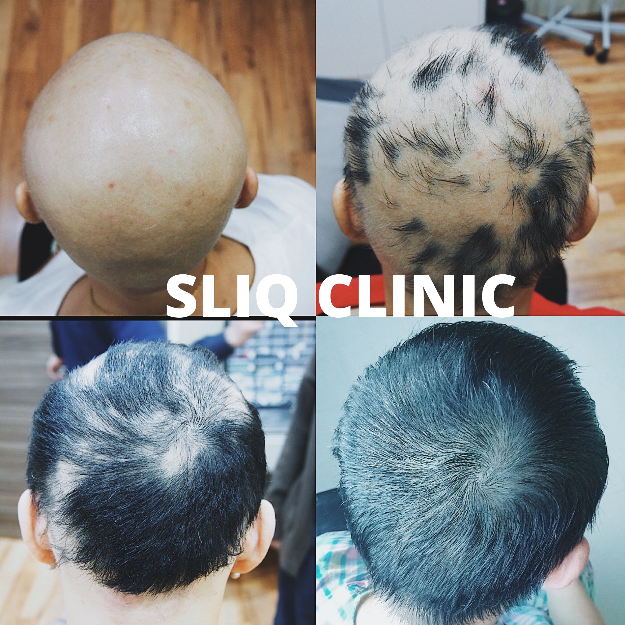 sliq clinic alopecia treatment kl pj